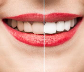 best methods for teeth whitening from expert dentist in Glen Allen