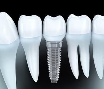 cost effective dental implant for missing teeth from expert dentist in Glen Allen