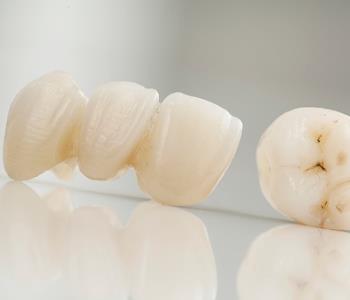 Glen Allen area dentist explains dental bridge options
