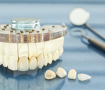 dental crowns and bridges from dentist in Charlottesville