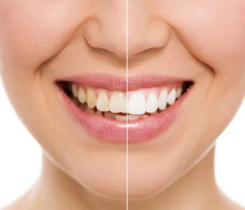 Home teeth whitening solutions from expert dentist in Glen Allen