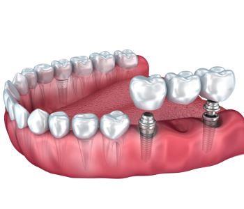 missing teeth solutions dental implants from dentist in richmond, va