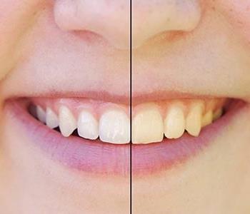 effective teeth whitening solutions from expert dentist in Fredericksburg, VA