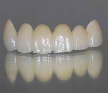 Zirconia implants are part of the healthy biological treatment approach at Virginia Biological Dentistry.