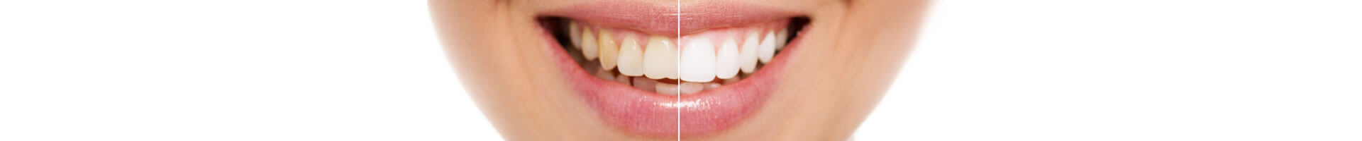 Teeth Whitening Glen Allen VA