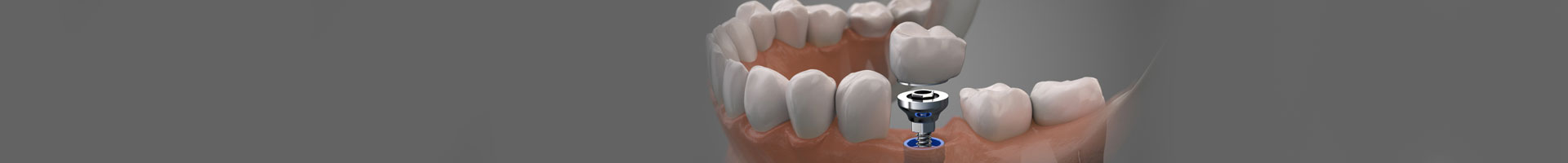 Removal of Metal Teeth