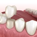 The Technology Which Makes Convenient CEREC Same-Day Ceramic Crowns Possible