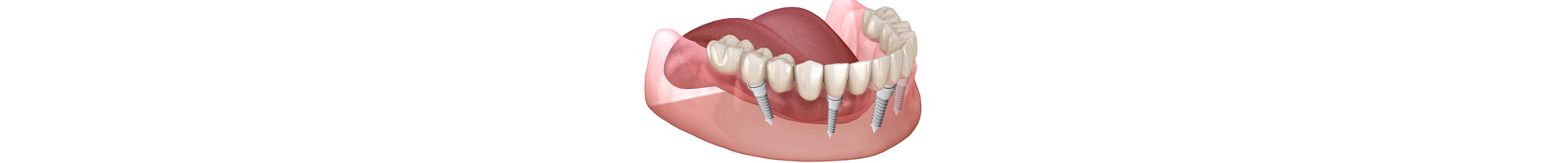 Full Mouth Reconstruction: Functional, Biocompatible, and Beautiful-looking All-on-6 Ceramic Implants